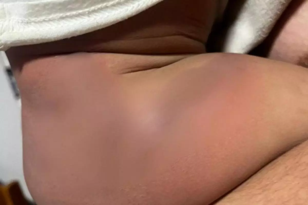 Bebê que sofreu queimaduras em creche recebe alta em Bauru