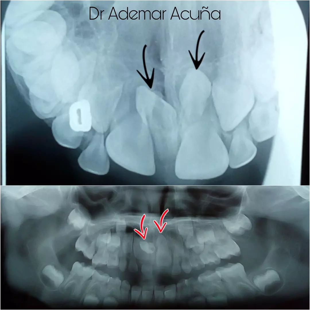 Extrações Dentárias Complexas Extrações Dentárias Complexas