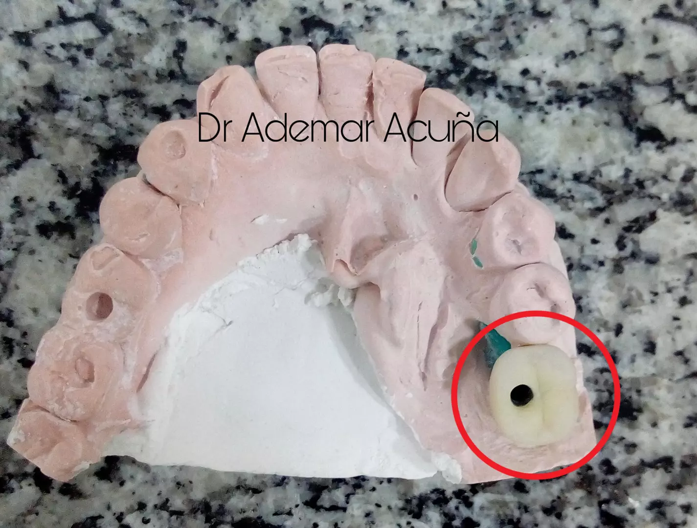 Implante Dentário Implante Dentário