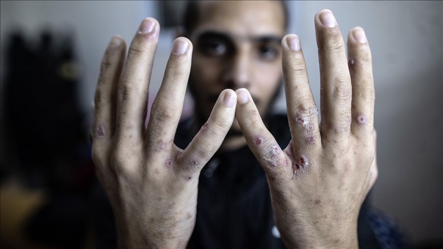 “israel” está contaminando presos palestinos com doenças infecciosas de forma deliberada