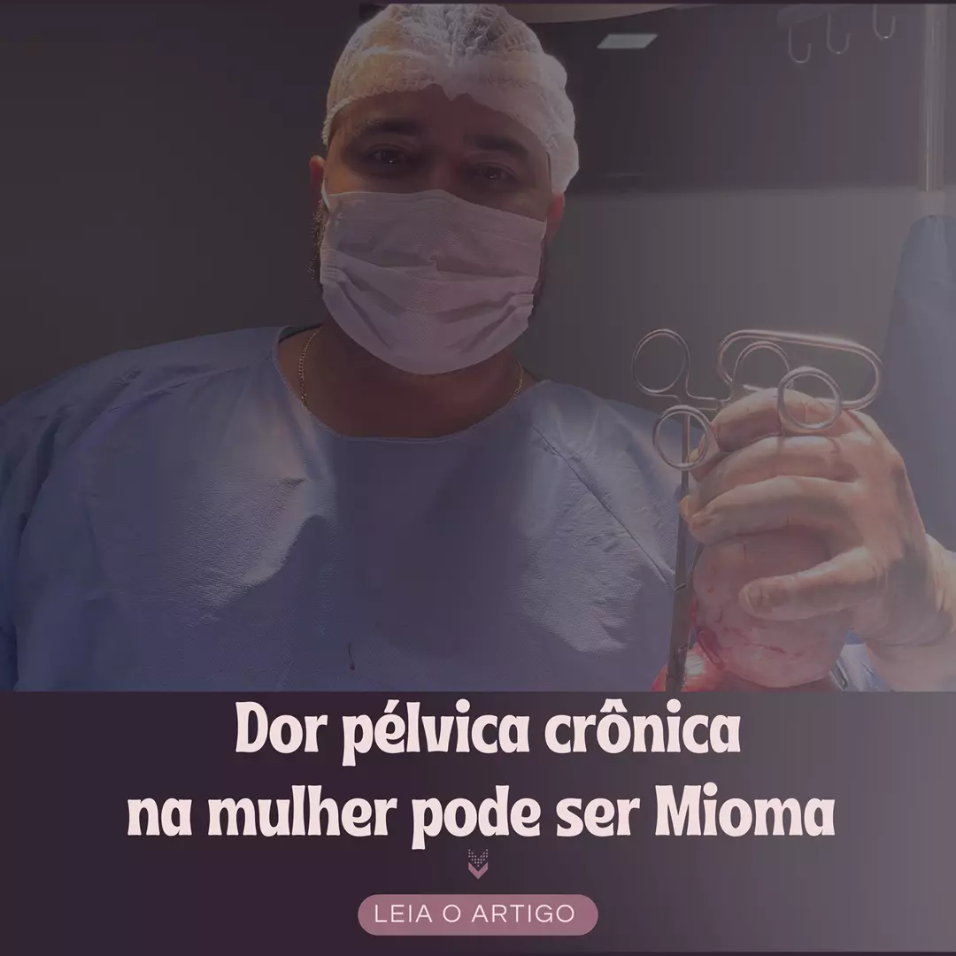 Miomatose Uterina: o que é e quando a cirurgia é indicada? Miomatose Uterina: o que é e quando a cirurgia é indicada?