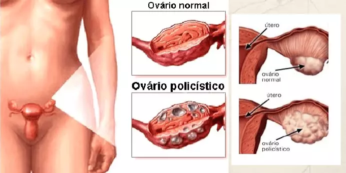 Síndrome dos Ovários Policísticos (SOP): será mesmo que você tem? Síndrome dos Ovários Policísticos (SOP): será mesmo que você tem?