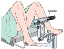 Colposcopia: saiba mais sobre este importante exame Colposcopia: saiba mais sobre este importante exame