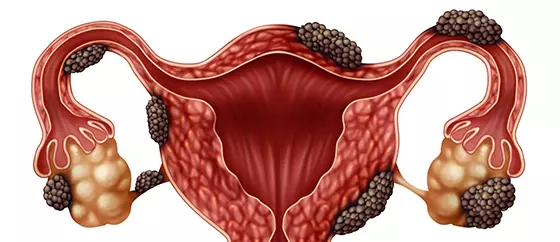 Endometriose: o que você precisa saber? Endometriose: o que você precisa saber?