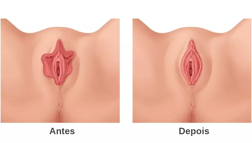 Ninfoplastia: entenda o procedimento Ninfoplastia: entenda o procedimento