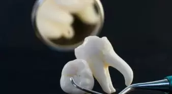 Por que é importante restaurar um dente após o tratamento de canal?
