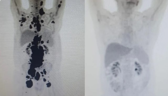Autorizados testes em humanos de tratamento que modifica células do próprio paciente de câncer
