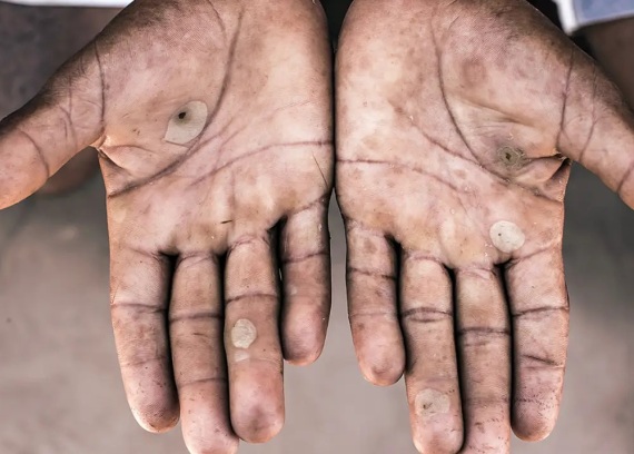 MT tem 11 empregadores na “lista suja” do trabalho escravo; veja nomes