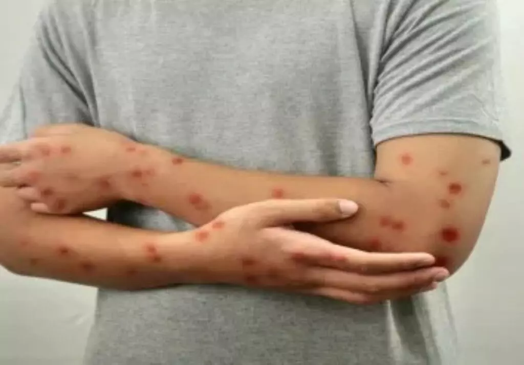 Mpox no Brasil: Rondônia sobe no ranking e já é o 3º estado com mais confirmações