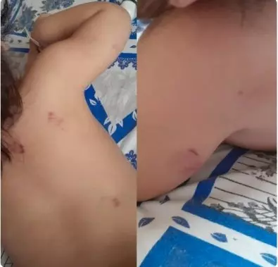 Bebê de 1 ano volta para casa com 17 mordidas e pais denunciam creche
