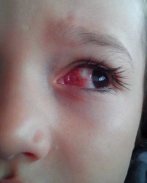 Indígena é preso suspeito de espancar e estuprar menina de 3 anos; criança está na UTI