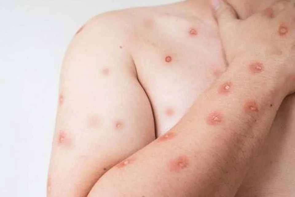 Saúde confirma primeiro caso de nova cepa de mpox no Brasil