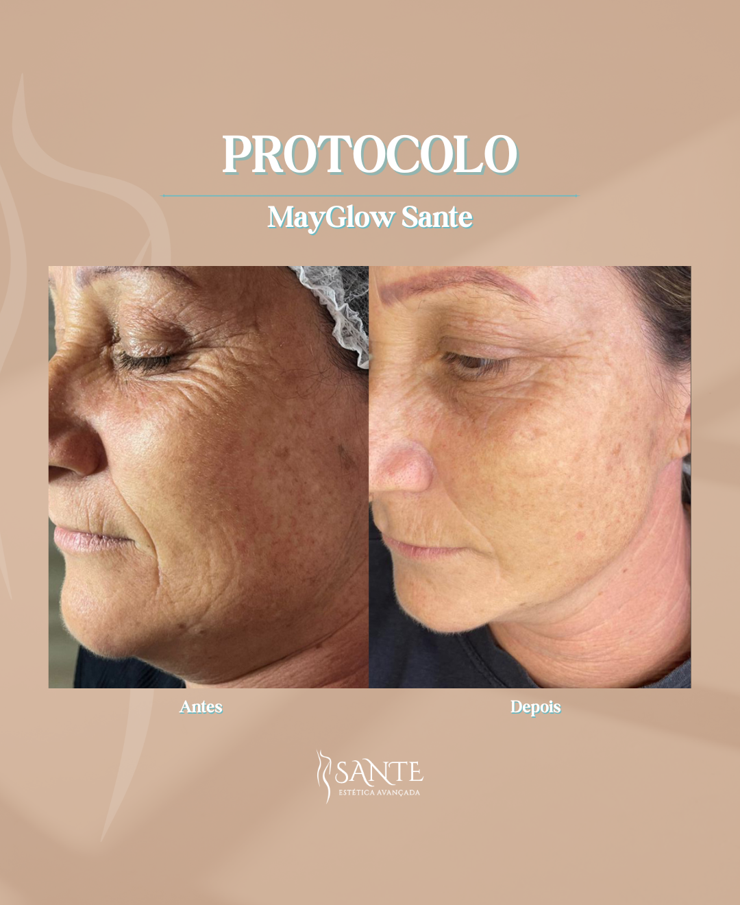 TRANSFORMAÇÕES FACIAIS COM HIPRO