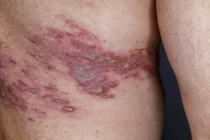 Saiba quais são os perigos do herpes-zóster e as formas de prevenção
